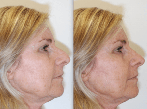 results from ent surgery