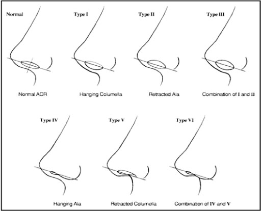 Hanging Columella - Dr Jason Roth | ENT Facial Plastic Surgery