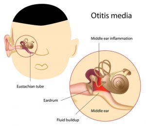 Middle ear infection