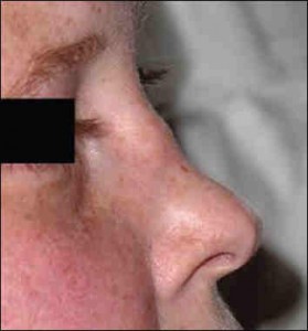 Saddle nose deformity