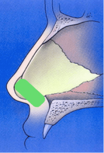 Septal extension graft Dr Roth rhinoplasty