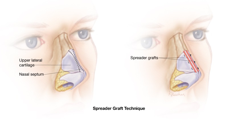 Spreader-grafts-Dr-Roth-rhinoplasty