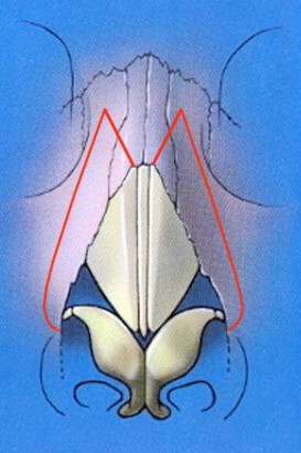 Wide Nasal Bridge Surgeon Sydney | Dr Jason Roth FRACS