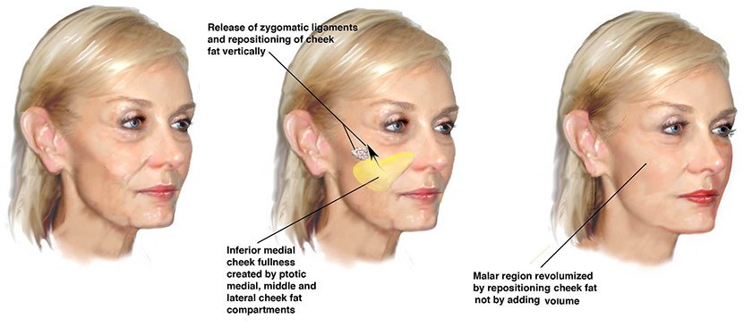 deep-plane-facelift-sydney-rhytidectomy-australia-smas-facelift-au