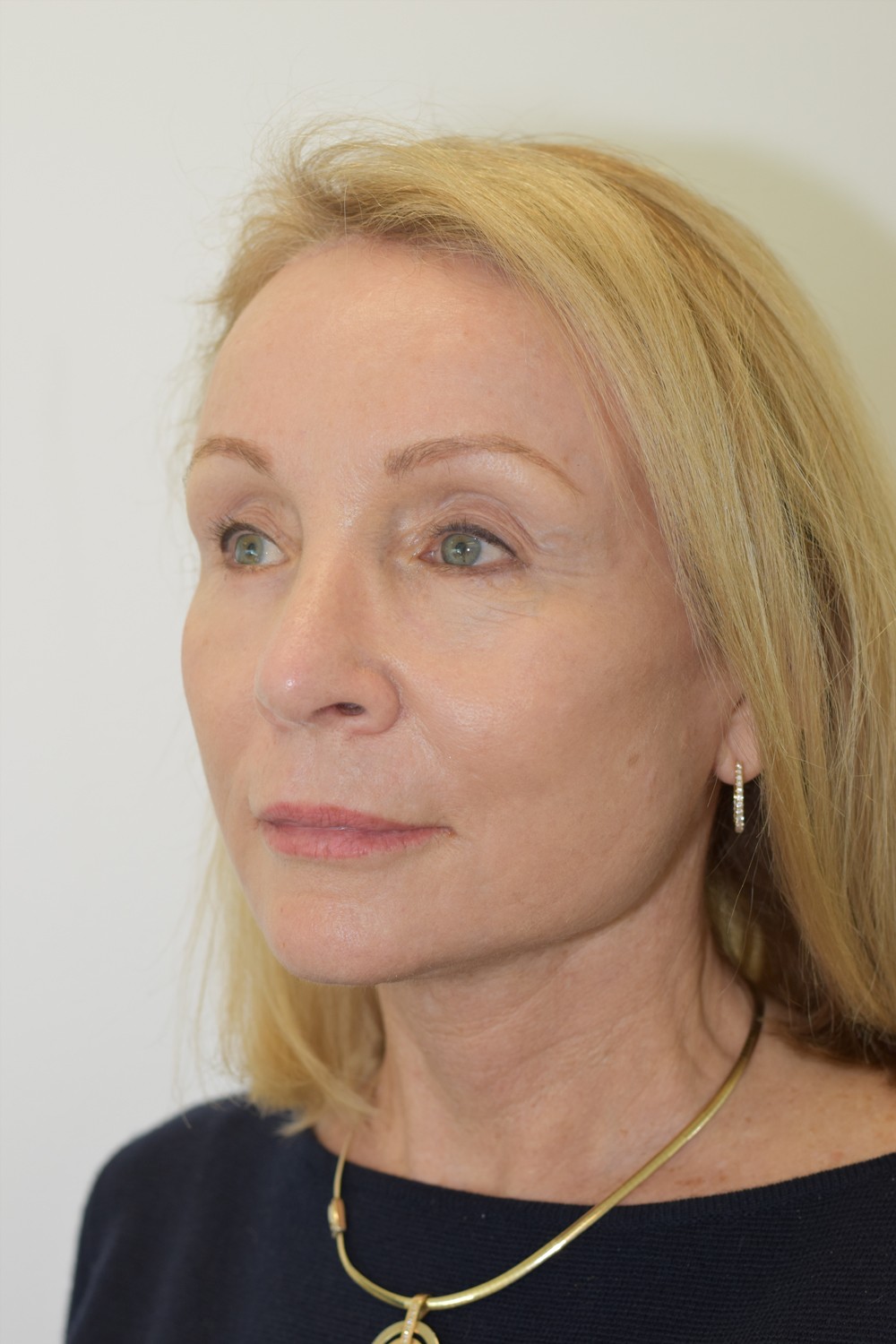 Neck lift after — Dr Jason Roth, Specialist Otolaryngologist Sydney