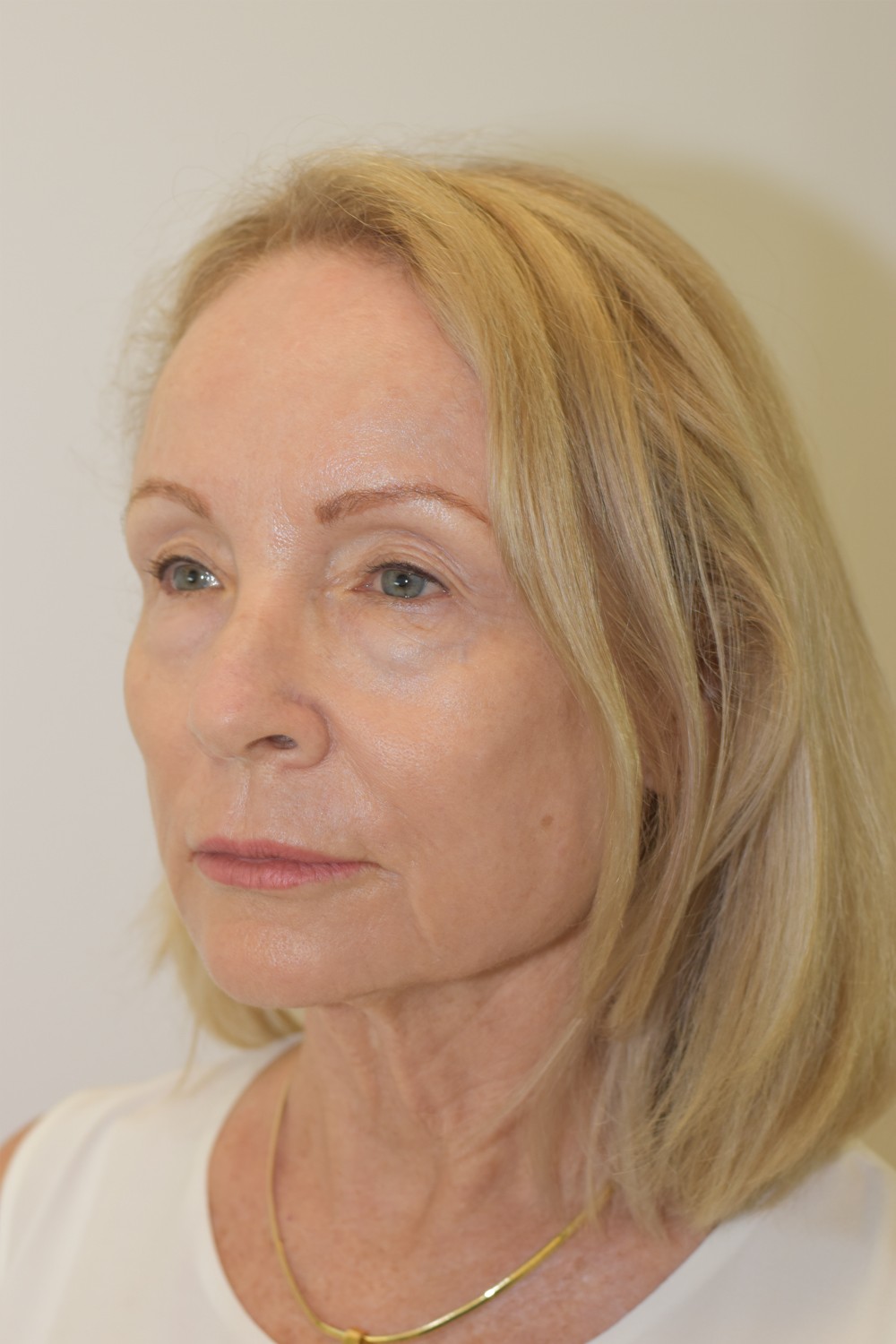 Neck lift before — Dr Jason Roth, Specialist Otolaryngologist Sydney
