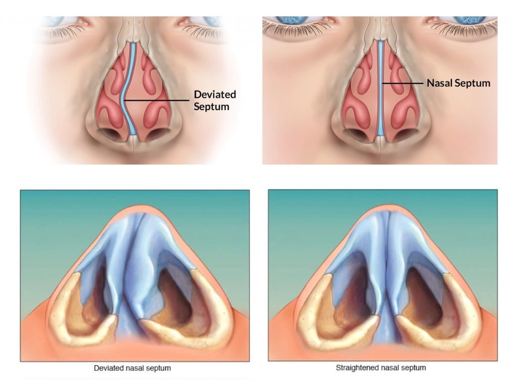 deviated and straightened septum