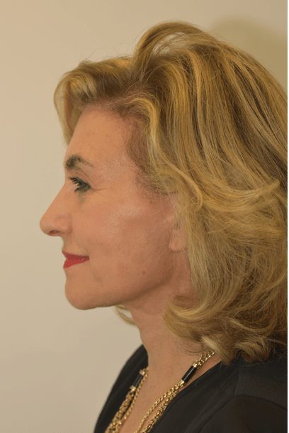 Deep plane facelift after — Dr Jason Roth