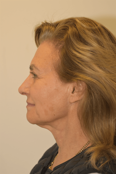 Deep plane facelift before — Dr Jason Roth