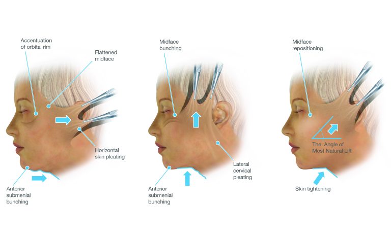 Deep Plane Facelift Surgeon Sydney | Dr Jason Roth FRACS