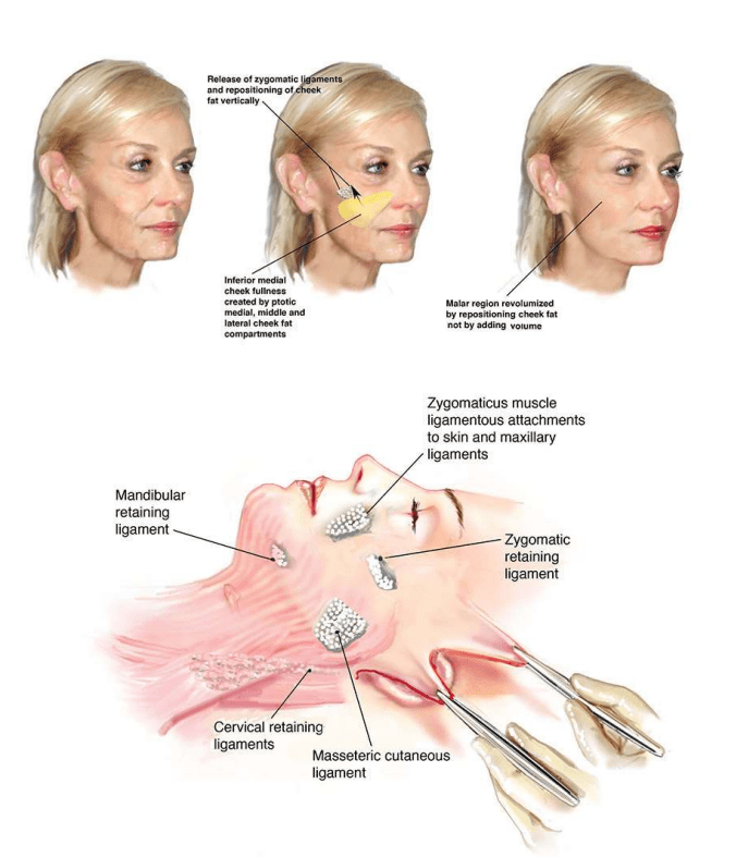 Jason Roth Ent Pre Operative FaceLift Information - Dr Jason Roth | ENT Facial Plastic ...